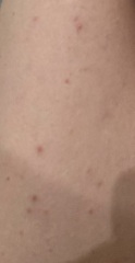 Can anyone identify this rash.....