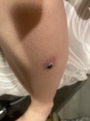 This mole - ? Melanoma? (Pics)