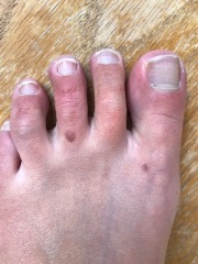New mole on foot out of nowhere! Thoughts please?!