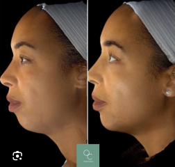 To be glad that people are realising the effects of filler!