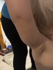 Is this chicken pox?