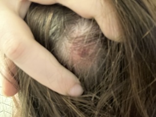 I think I have a cyst on top of my cyst (pics)