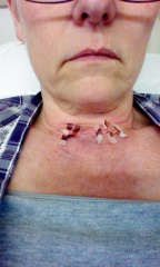 Graves’ disease overactive thyroid , surgery soon