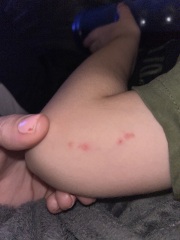Chicken pox?