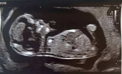 Boy or girl? Nub theory