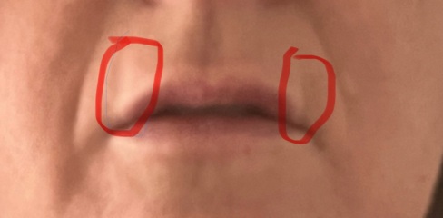 Lip Fillers - can I avoid this wrinkle?