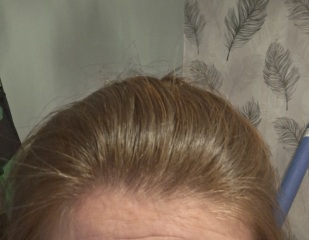 Losing hair on hairline