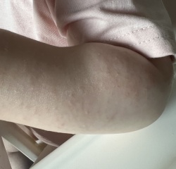 Eczema or intolerance?