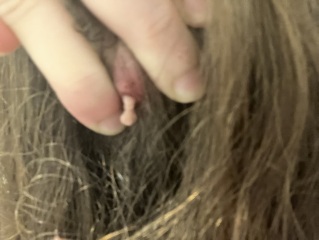 I think I have a cyst on top of my cyst (pics)
