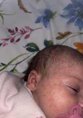 Baby acne?
