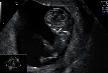 Any fun gender guesses? Early scan