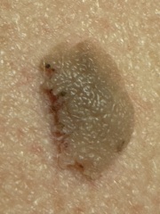 This mole - ? Melanoma? (Pics)