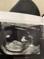 Baby ultrasound
