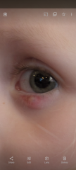 3yo stye (pic included!)