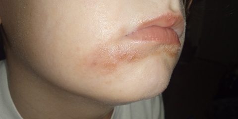 Can I have some advice about rash around dd's mouth please?