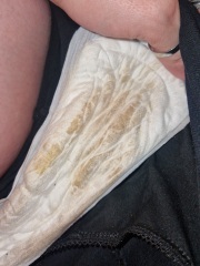 *TW* *graphic photos* discharge (doesn't look like plug)
