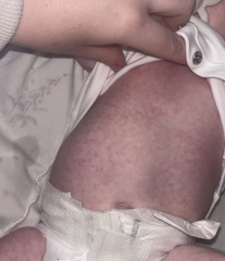 ? Milk allergy rash?