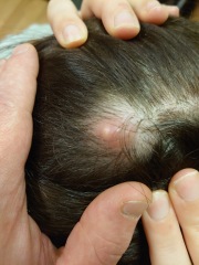 I think I have a cyst on top of my cyst (pics)