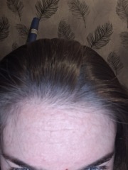 Losing hair on hairline