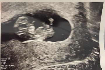 Nub theory boy or girl scan attached 😊 rainbow baby ♥️