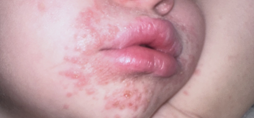 Impetigo?