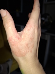 Hand infected (Warning, gross photos)