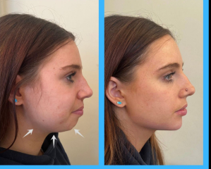 To be glad that people are realising the effects of filler!