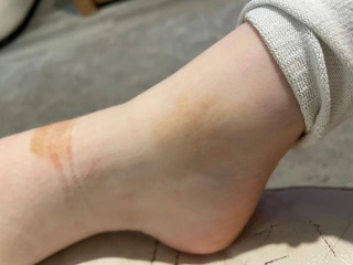 Strange 'rash' on 13 year old
