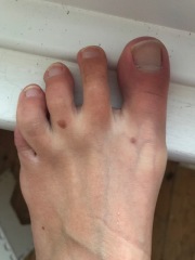 New mole on foot out of nowhere! Thoughts please?!