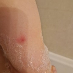 Chicken pox or bug bites