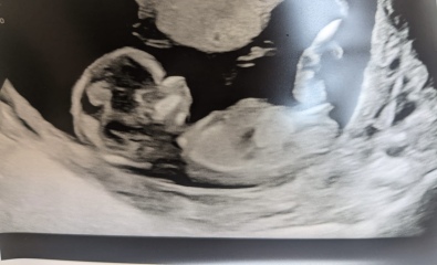 Gender guesses (13 week scan)