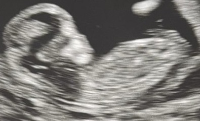 12 and 13 week scan