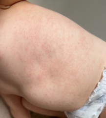 Baby rash