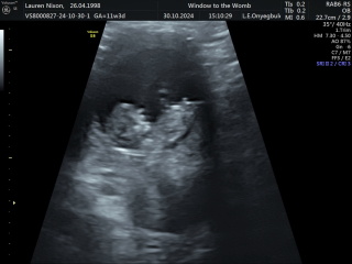 Any gender guesses now nub is visable? 11 weeks 3 days xx