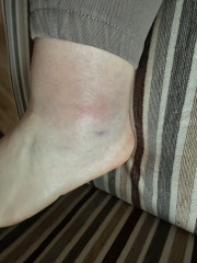 Making a complaint to the council after injuring myself on a wonky pavement