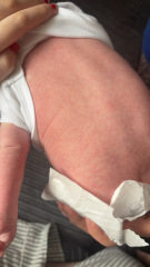 ? Milk allergy rash?