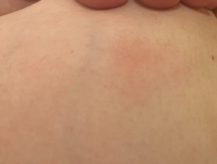 Hand holding - worried about a small rash (picture)