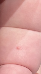 6 month old pimples/blisters??