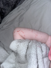 Hand foot and mouth advice needed