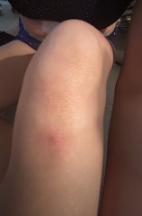 Knee zit!