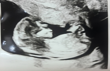13 week scan, boy or girl?