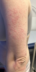 Horrible body rash!