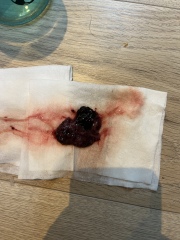 TW//Miscarriage tissue??