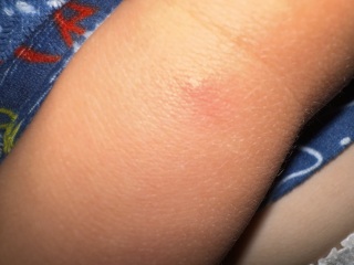 Is this chicken pox?