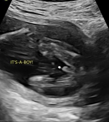 Can a 17 week boy gender scan be wrong?