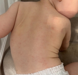 Baby rash