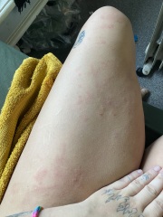 Horrible body rash!