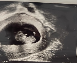 Nub theory boy or girl scan attached 😊 rainbow baby ♥️