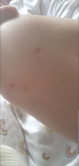 Chicken pox or bug bites