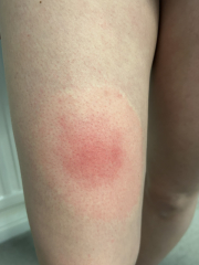 Lyme disease or ringworm?